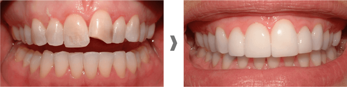 Carillas dentales sin rebajar el diente en Sant Boi de Llobregat