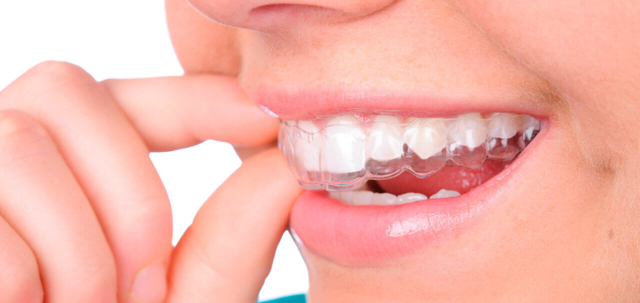 invisalign barcelona barato