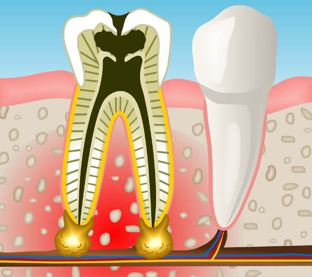Endodoncia en Sant Boi de Llobregat