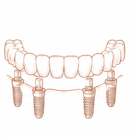 Técnica All-on-4 en Centre Dental Basté, Sant Boi de Llobregat