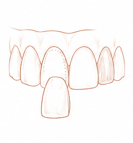carillas dentales — Centre Dental Basté