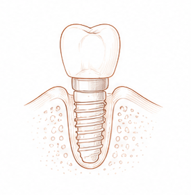 implantología — Centre Dental Basté
