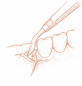 regeneración ósea periodontal — Centre Dental Basté