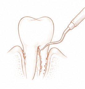 Qué es periodoncia — Centre Dental Basté