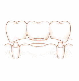 prótesis — Centre Dental Basté