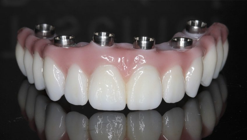 Intestinos equivocado nuestra Anímate a utilizar dentadura postiza fija | Centre Dental Baste