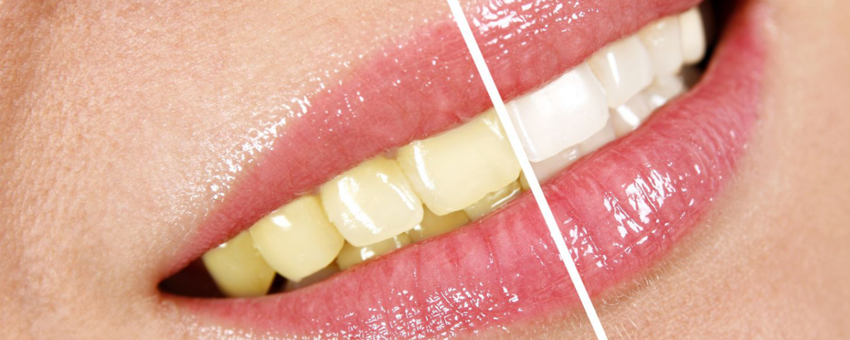 tratamiento dientes amarillos sant boi de llobregat