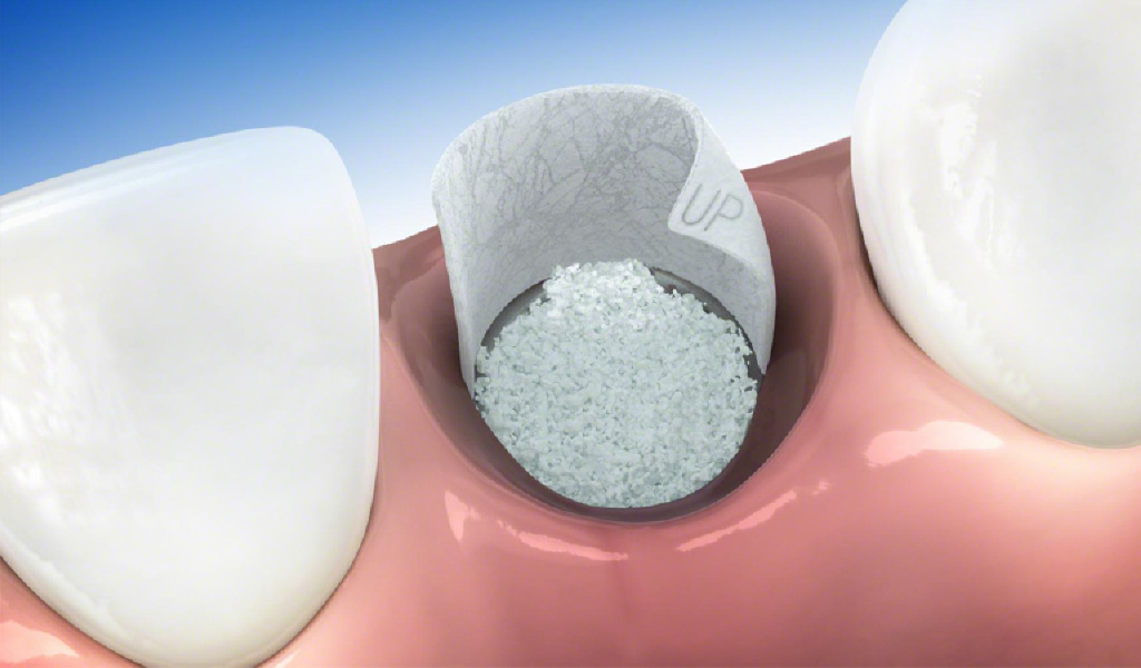 implantes dentales en Sant Boi de Llobregat