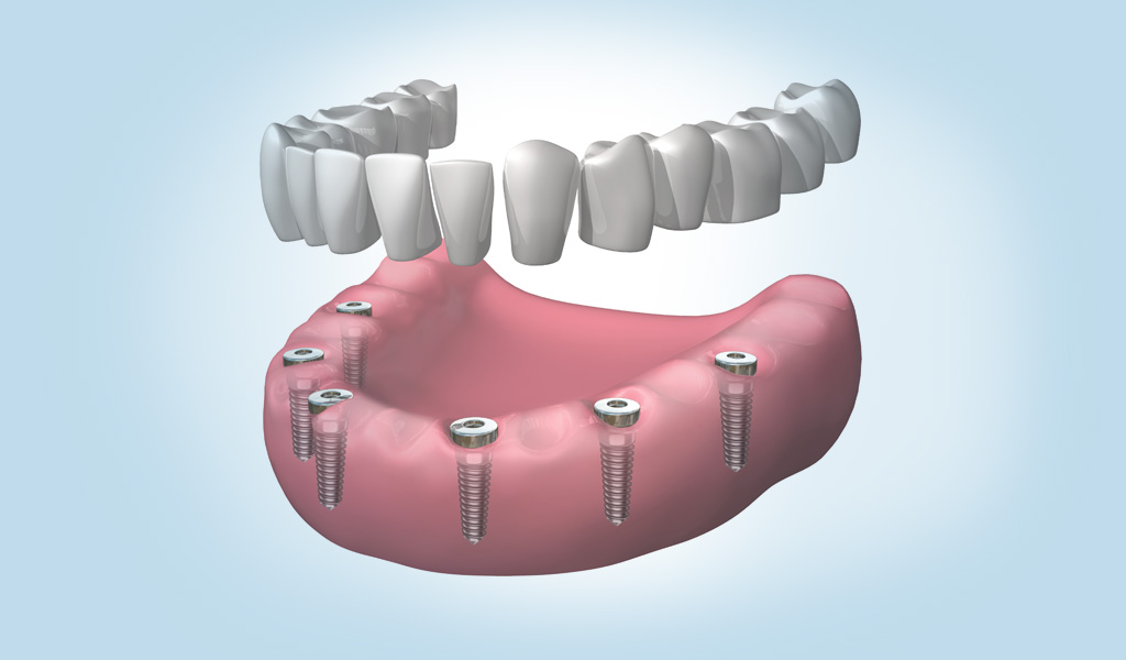 implantes dentales en Sant Boi del Llobregat
