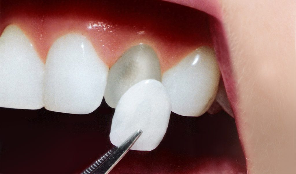 Estética dental en Sant Boi de Llobregat