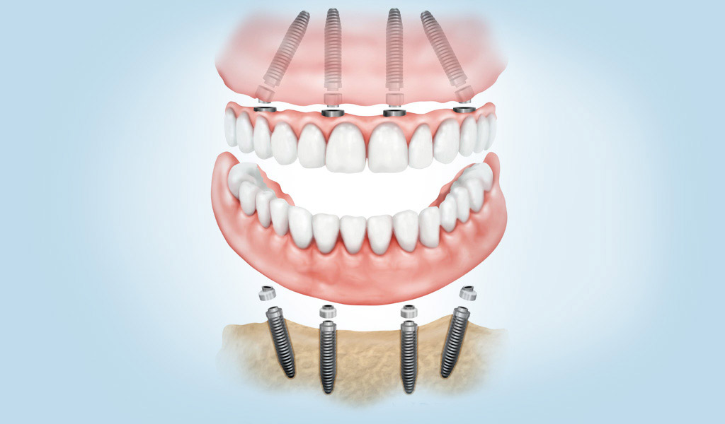 dentadura fijada con implantes dentales en Sant Boi de Llobregat