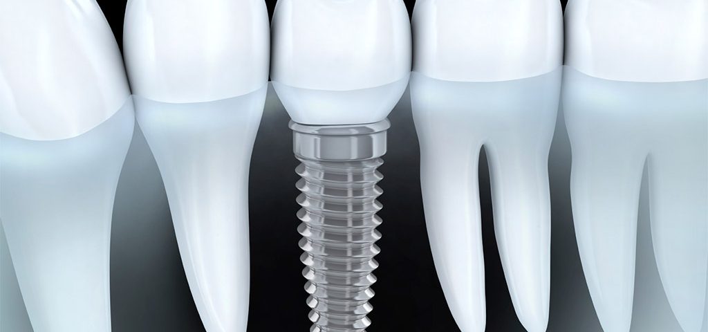 Implantología dental en Sant Boi de Llobregat
